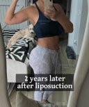 2 años después de liposucción con Dr. Mehmet Haşim Güner – resultado visible de contorno corporal