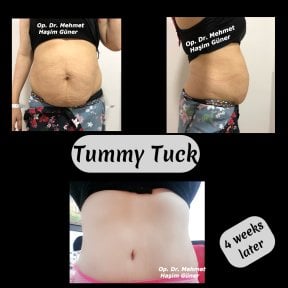 before-after photo abdominoplastika-i-liposakcia