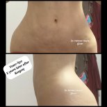 Vaser liposuction before and after results, 5 years post-surgery by Dr. Mehmet Haşim Güner
