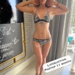 Vaser liposuction result after 11 months – slimmer waist and abdomen contour improvement