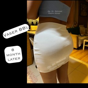Результат Vaser BBL через 8 місяців у доктора Мехмета Хашима Гюнера – покращений контур сідниць