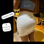 Результат Vaser BBL через 8 місяців у доктора Мехмета Хашима Гюнера – покращений контур сідниць