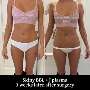 Результати до і після Skinny BBL з J Plasma, 3 тижні після операції у д-ра Мехмета Хашима Гюнера