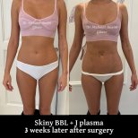 Результати до і після Skinny BBL з J Plasma, 3 тижні після операції у д-ра Мехмета Хашима Гюнера