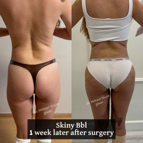 До і після Brazilian Butt Lift у доктора Мехмета Хашима Гюнера, помітний контур