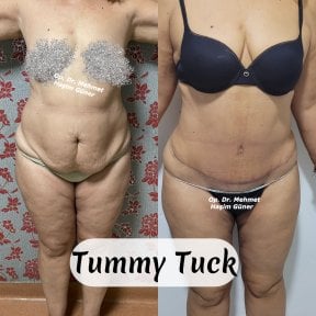 before-after photo abdominoplastika-i-liposakcia