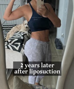 2 años después de liposucción con Dr. Mehmet Haşim Güner – resultado visible de contorno corporal