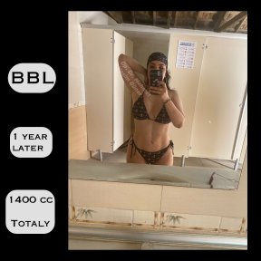 Результат Brazilian Butt Lift через 1 рік, 1400cc жиру, помітне покращення контурів тіла