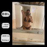 Результат Brazilian Butt Lift через 1 рік, 1400cc жиру, помітне покращення контурів тіла