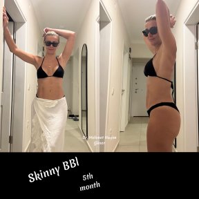 Результати Skinny BBL через 5 місяців після операції у Dr. Mehmet Haşim Güner, покращений контур