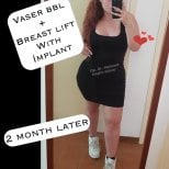 Результати Vaser BBL і підтяжки грудей з імплантом через 2 місяці у д-ра Гюнера
