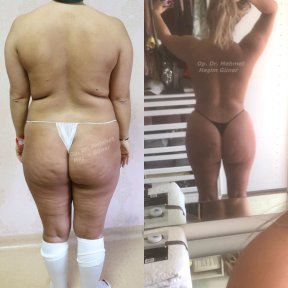 Результати до і після Brazilian Butt Lift у доктора Мехмета Хашима Гюнера, покращені форми