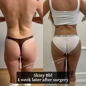 Before and after skinny BBL results, 1 week post-surgery by Dr. Mehmet Haşim Güner