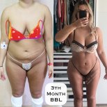 До та після Brazilian Butt Lift у клініці Dr. Mehmet Haşim Güner, результат за 3 місяці
