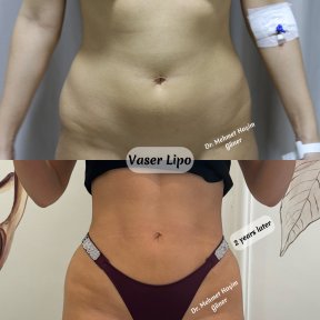 Before and after Vaser liposuction results by Dr. Mehmet Haşim Güner, abdomen contouring