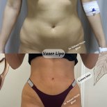 Before and after Vaser liposuction results by Dr. Mehmet Haşim Güner, abdomen contouring