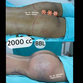 Before and after BBL results at Dr. Mehmet Haşim Güner clinic, 2000cc fat transfer
