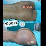Before and after BBL results at Dr. Mehmet Haşim Güner clinic, 2000cc fat transfer