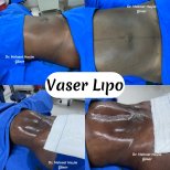 Resultados antes y después de Vaser lipo con Dr. Mehmet Haşim Güner, abdomen definido