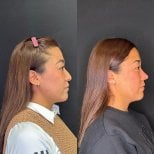 Resultados de rinoplastia antes y después en Zafir Medical Center, mejora de la nariz