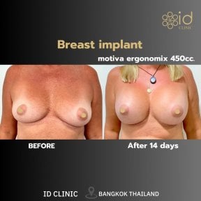 Результаты до и после увеличения груди Motiva в ID Clinic Bangkok, 14 дней после