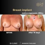 До и после увеличения груди имплантами Motiva в ID Clinic Bangkok, результат за 14 дней