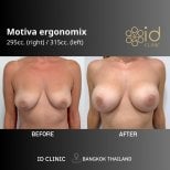 Результаты до и после увеличения груди в ID Clinic Bangkok с имплантами Motiva Ergonomix
