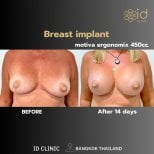 До и после увеличения груди с имплантами Motiva в ID Clinic Bangkok, результат за 14 дней