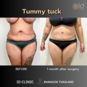 Результаты до и после абдоминопластики в ID Clinic Bangkok, улучшение контура живота