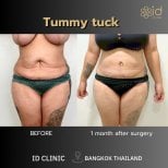 Результаты до и после абдоминопластики в ID Clinic Bangkok, улучшение контура живота