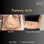 Результаты до и после абдоминопластики в ID Clinic Bangkok – улучшение контура живота