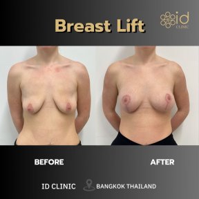 Результаты до и после подтяжки груди в ID Clinic Bangkok – улучшенный контур груди