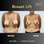 Результаты до и после подтяжки груди в ID Clinic Bangkok – улучшение контура груди