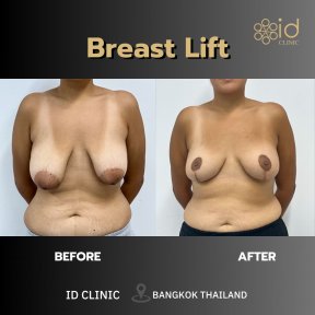 Результаты до и после подтяжки груди в ID Clinic Bangkok – улучшена форма и контур груди
