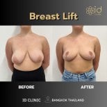 Результаты до и после подтяжки груди в ID Clinic Bangkok, улучшенный контур груди