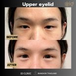 Результаты блефаропластики верхних век до и после в ID Clinic Bangkok, улучшенный вид глаз
