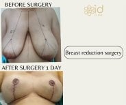 Результаты до и после уменьшения груди в ID Clinic Bangkok, улучшенный контур груди