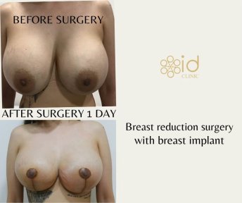 До и после уменьшения груди с имплантом в ID Clinic Bangkok, видимый результат