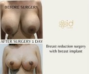 До и после уменьшения груди с имплантом в ID Clinic Bangkok, видимый результат