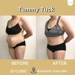 Результаты до и после абдоминопластики в ID Clinic Bangkok, улучшение контура живота