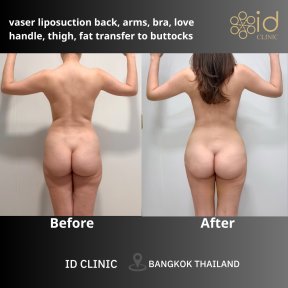 Результаты до и после Vaser липосакции и липофилинга ягодиц в ID Clinic Bangkok