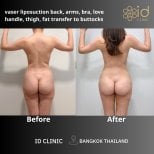 Результаты до и после Vaser липосакции и липофилинга ягодиц в ID Clinic Bangkok