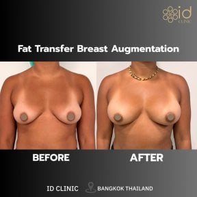Результаты до и после увеличения груди липофилингом в ID Clinic Bangkok