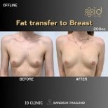 Результат до и после липофилинга груди в ID Clinic Bangkok, естественное увеличение груди
