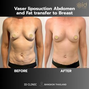 Результаты до и после Vaser липосакции живота и липофилинга груди в ID Clinic Bangkok