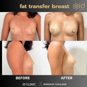 Результаты до и после липофилинга груди в ID Clinic Bangkok, естественный контур