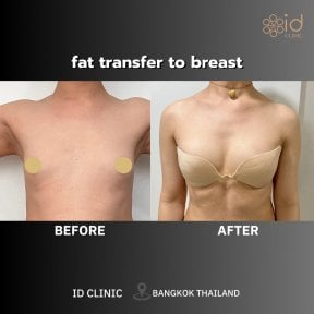 Результат липофилинга груди до и после в ID Clinic Bangkok, естественное увеличение груди