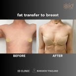 Результат липофилинга груди до и после в ID Clinic Bangkok, естественное увеличение груди