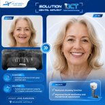 نتائج زراعة الأسنان قبل وبعد في مركز Lac Viet Intech Dental Center، ابتسامة مستعادة
