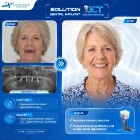 نتائج زراعة الأسنان قبل وبعد في مركز Lac Viet Intech Dental Center، ابتسامة مستعادة